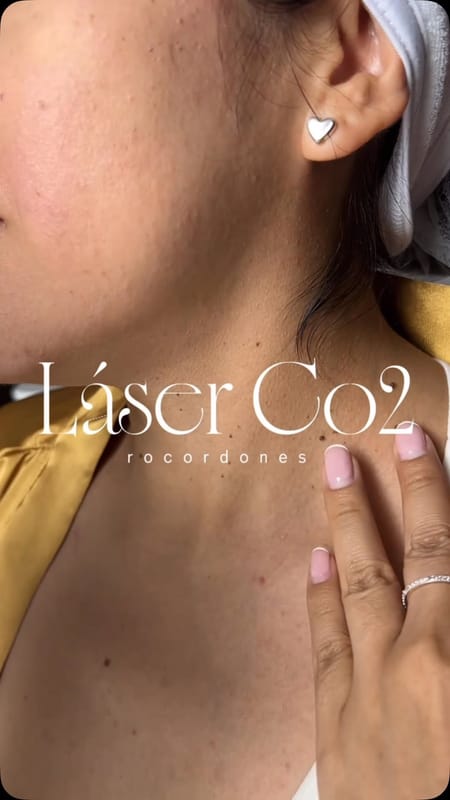 ¿Tienes esos pequeños “lunares de carne” que te incomodan? ✨
En Okara los retir