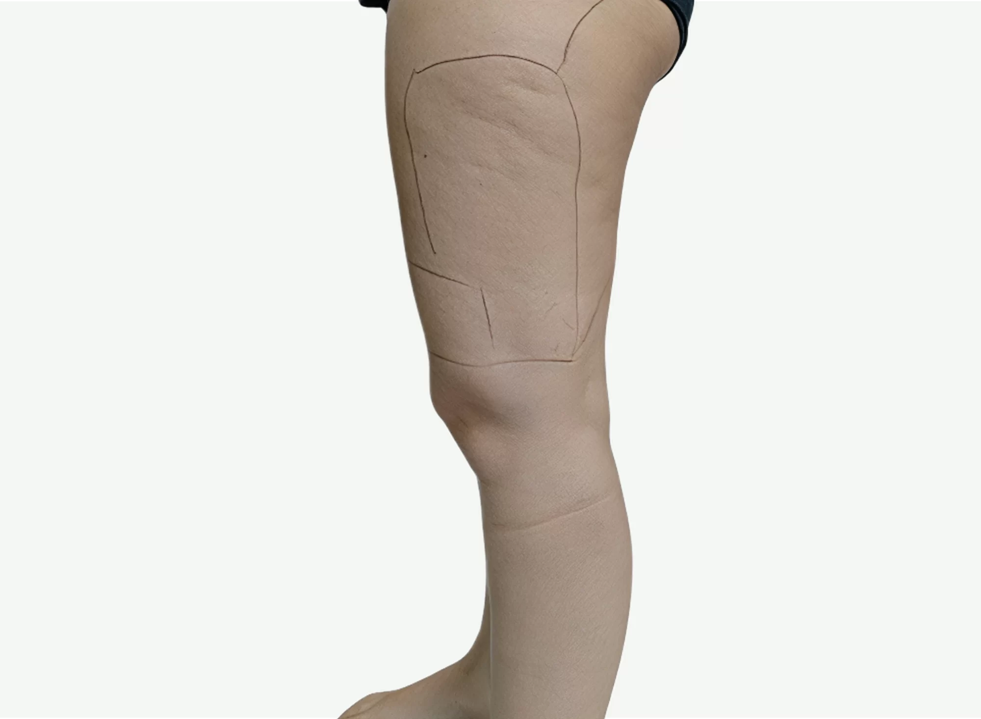 Celulitis — Antes