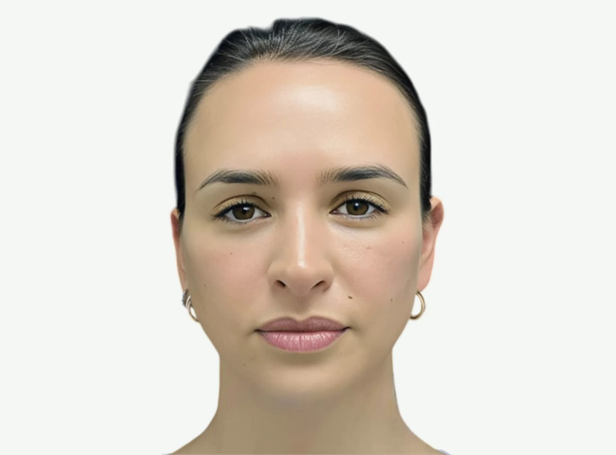 Colágeno Tipo I — Después