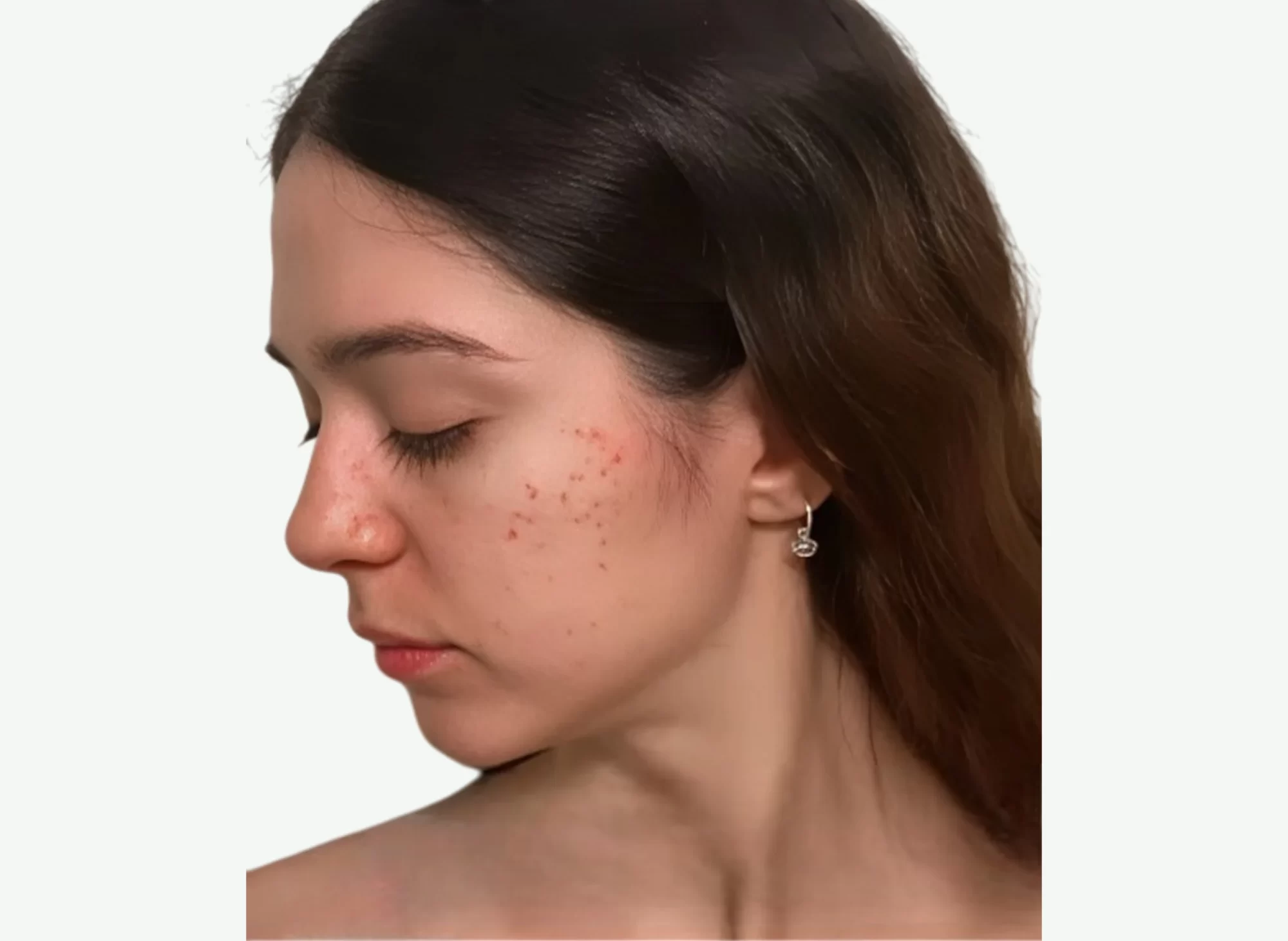 Dermapen · Microneedling — Antes