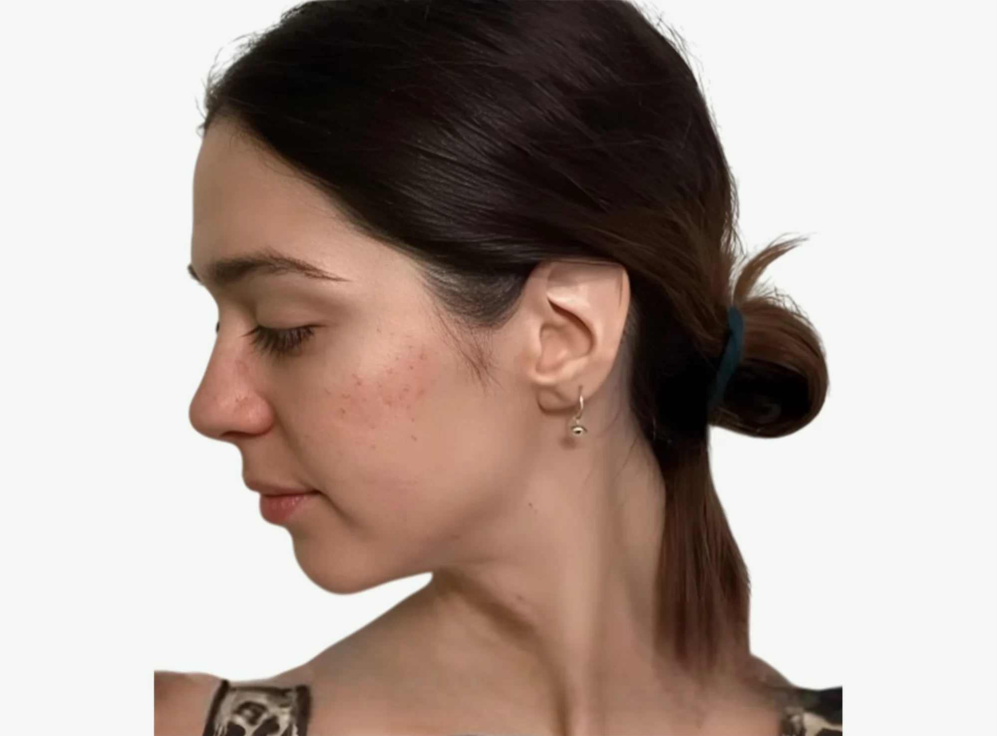 Dermapen · Microneedling — Después