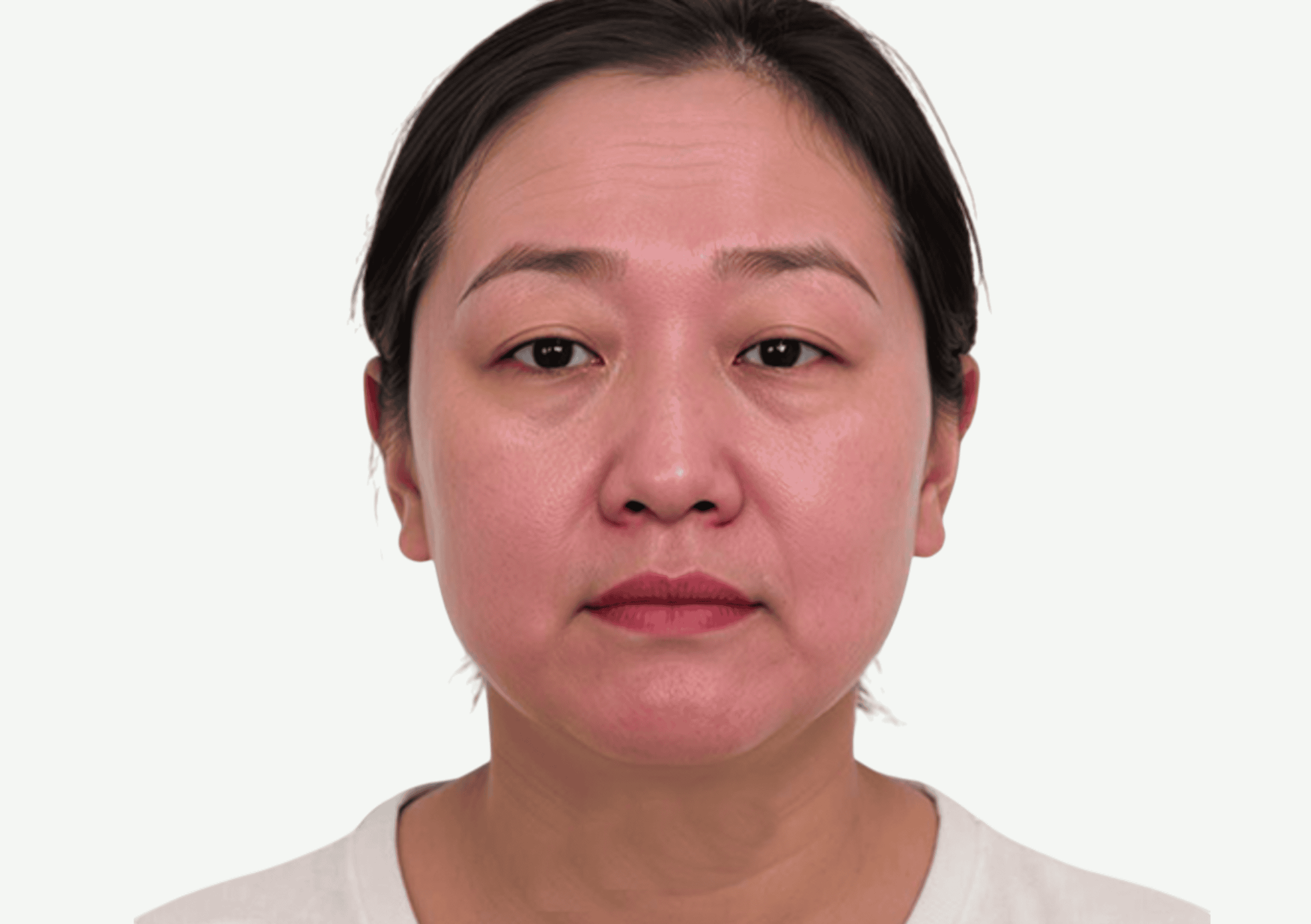 Flacidez Facial