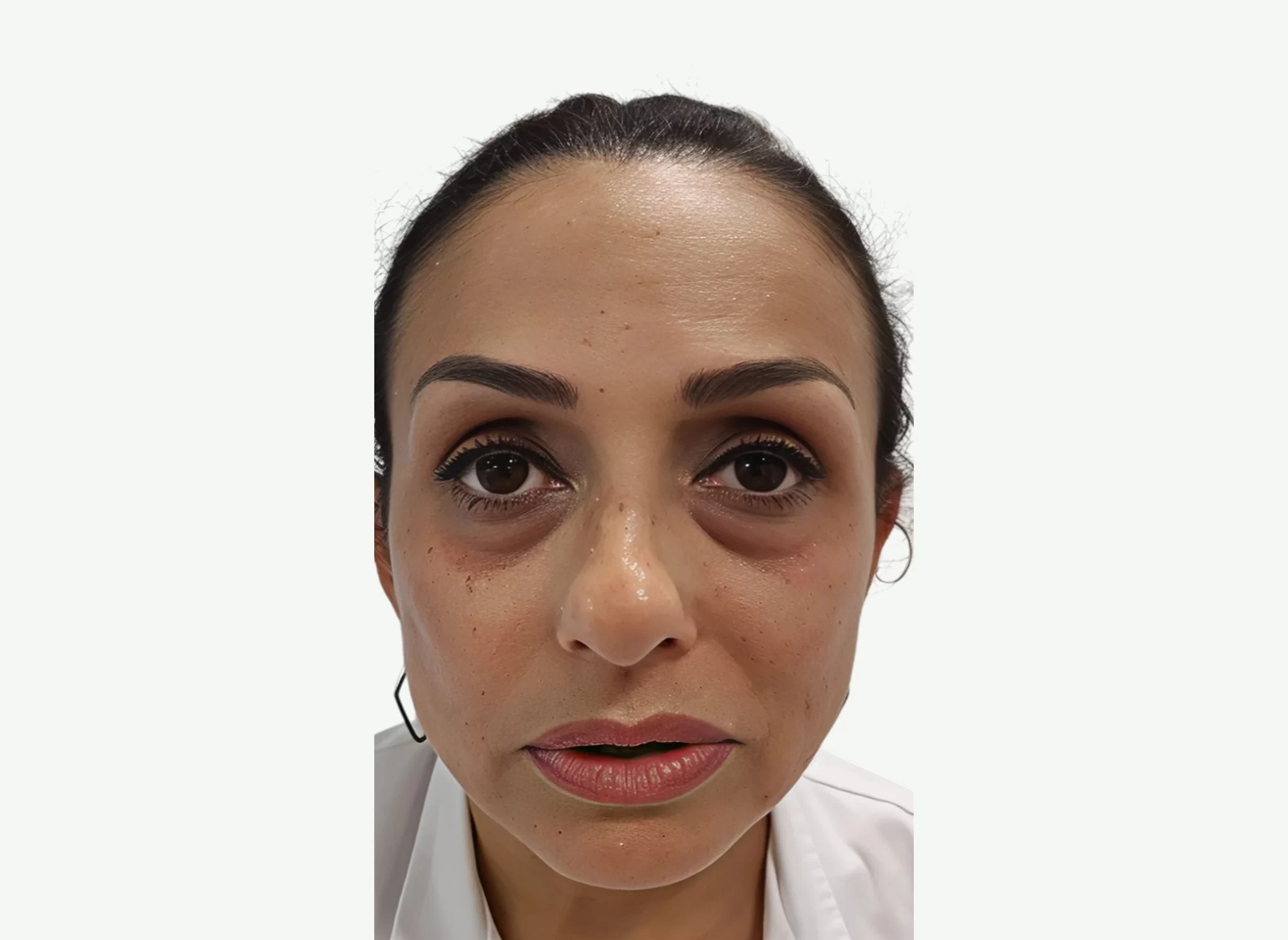 Ojeras y Bolsas — Antes
