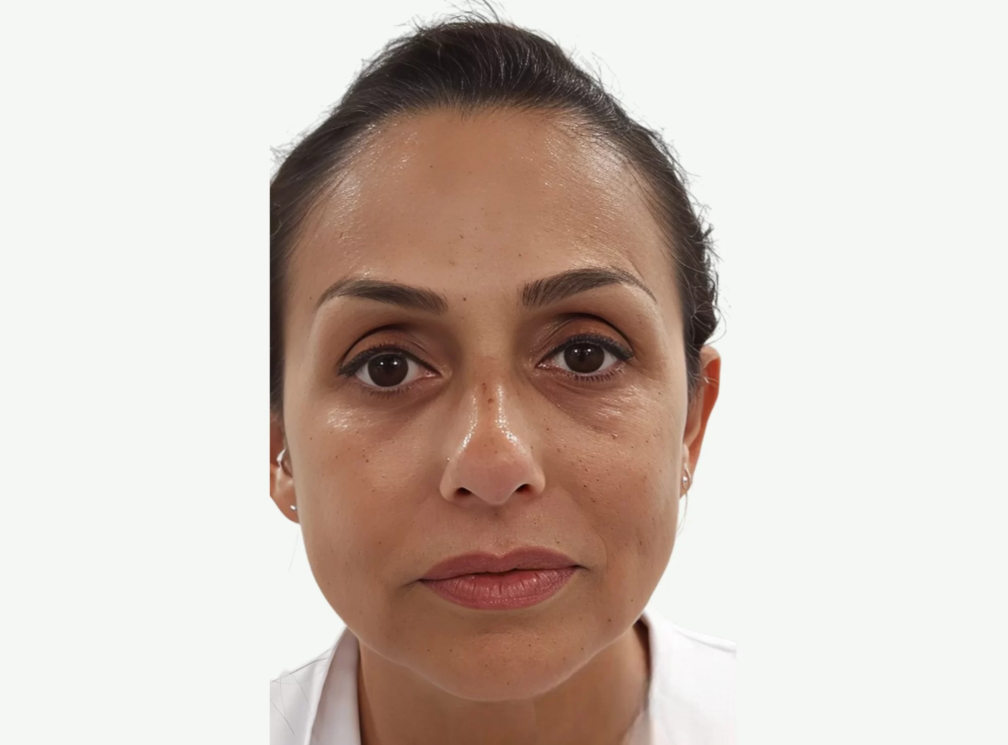 Ojeras y Bolsas — Después