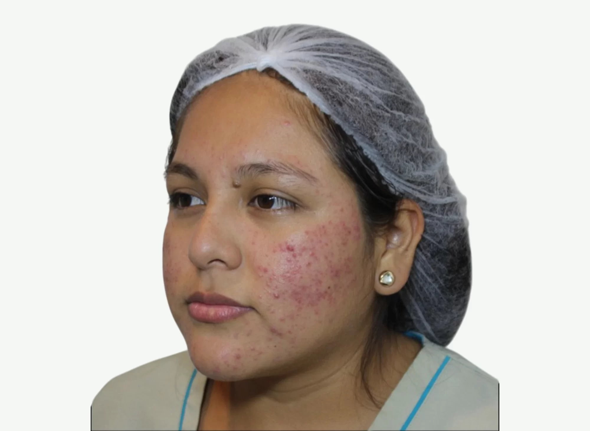 Ozonoterapia — Antes