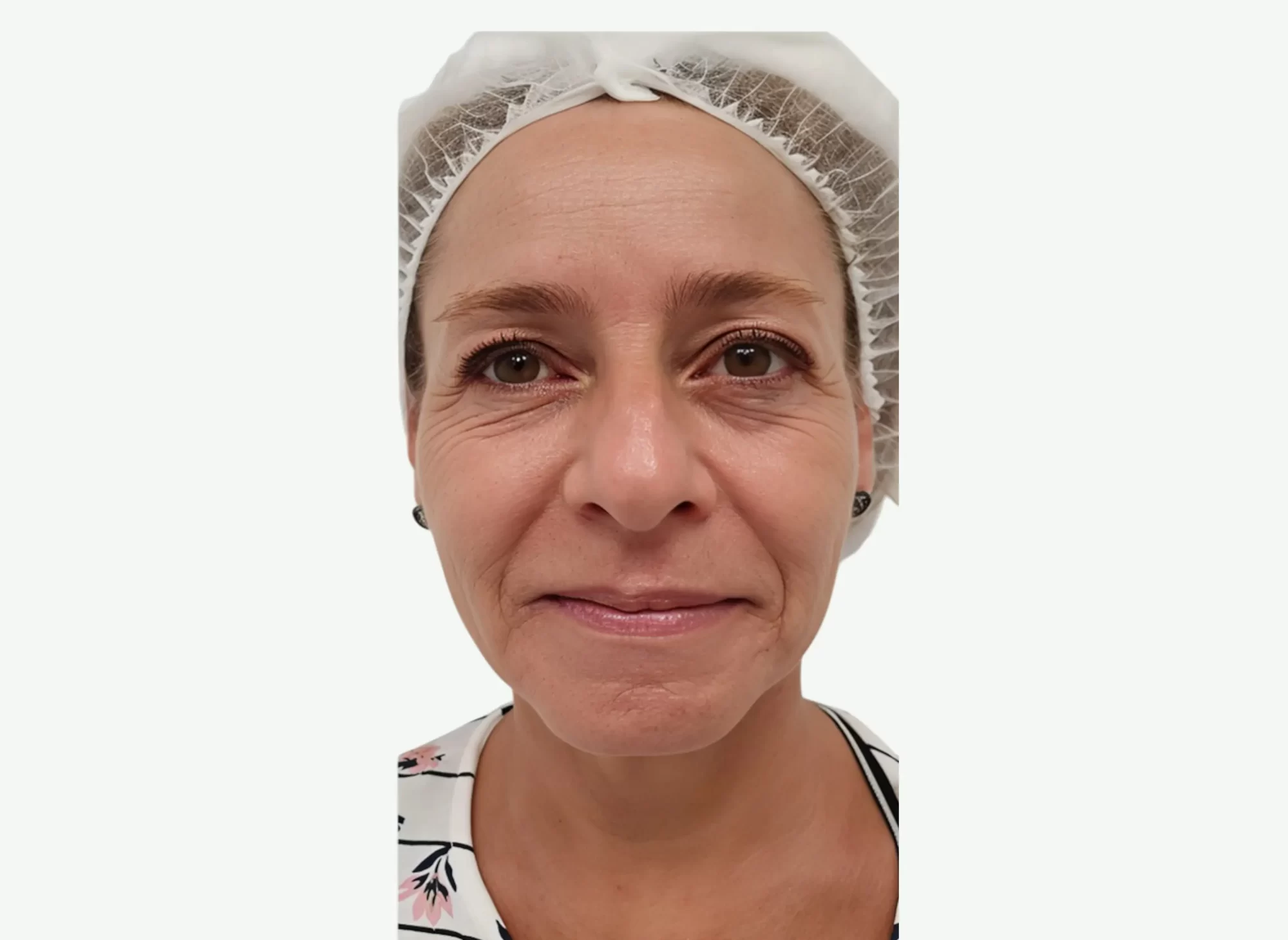 Rejuvenecimiento Facial — Antes