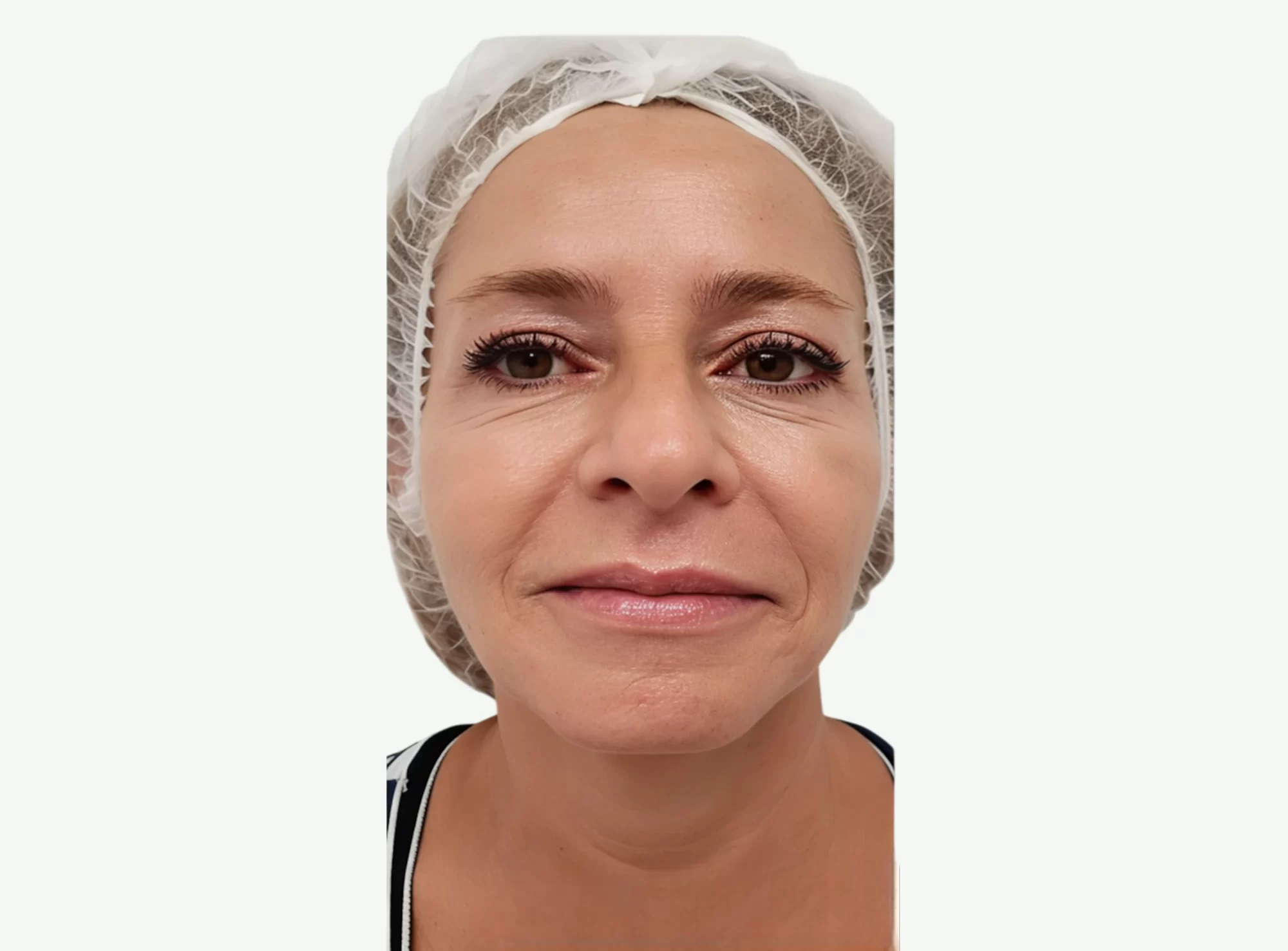 Rejuvenecimiento Facial — Después