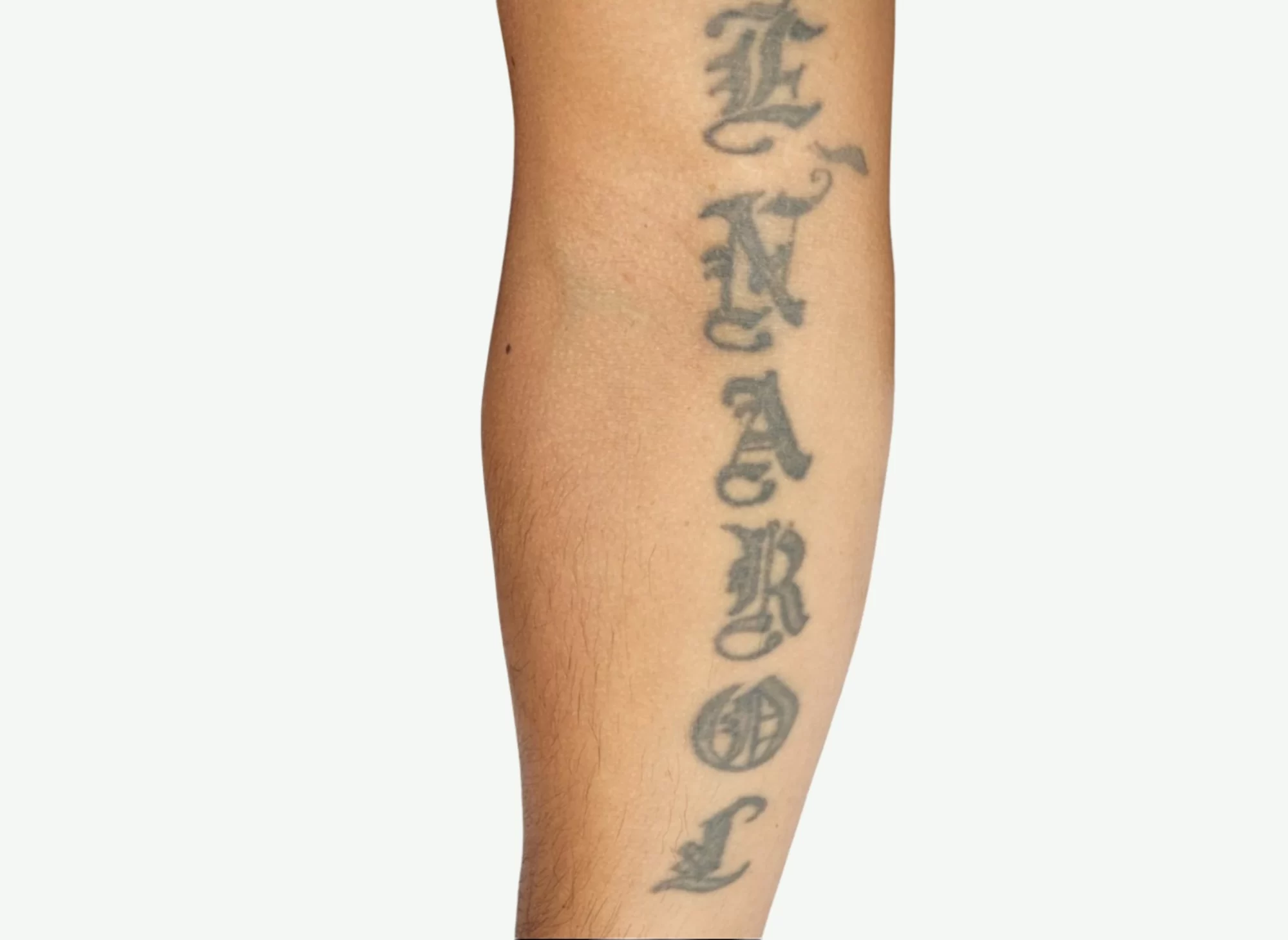 Remoción de Tatuajes — Antes