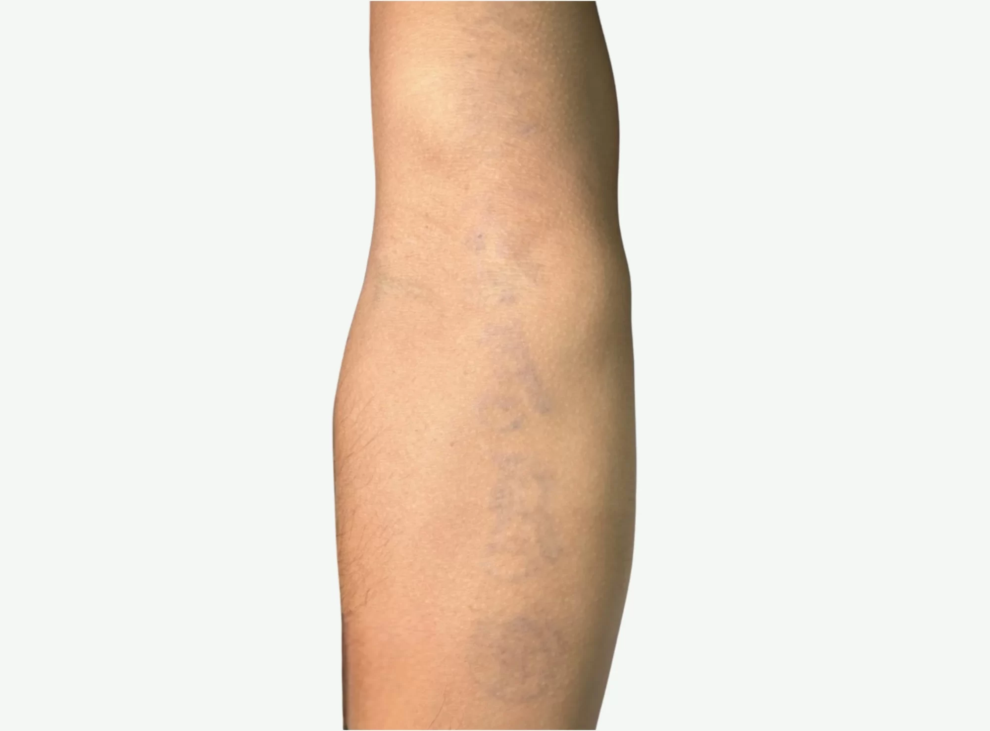 Remoción de Tatuajes — Después