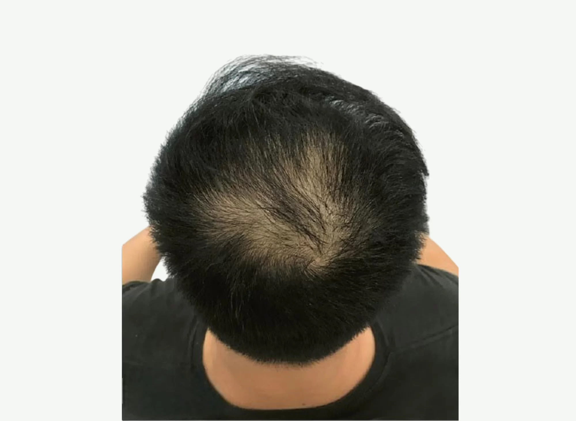 Tratamiento para la Caída del Cabello — Antes