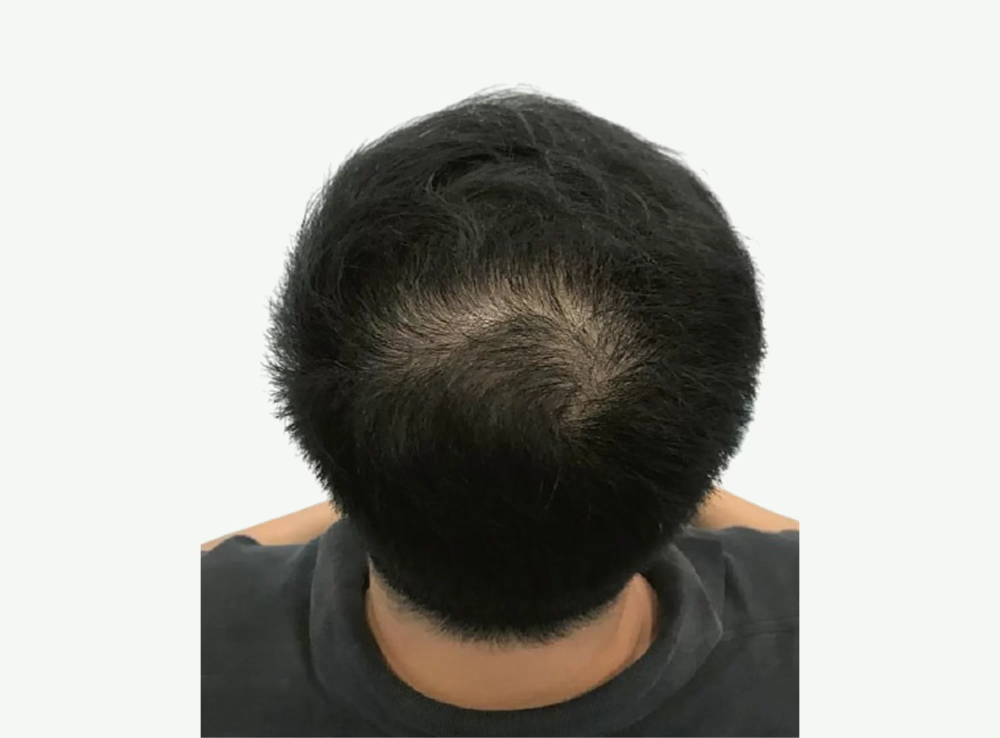 Tratamiento para la Caída del Cabello — Después