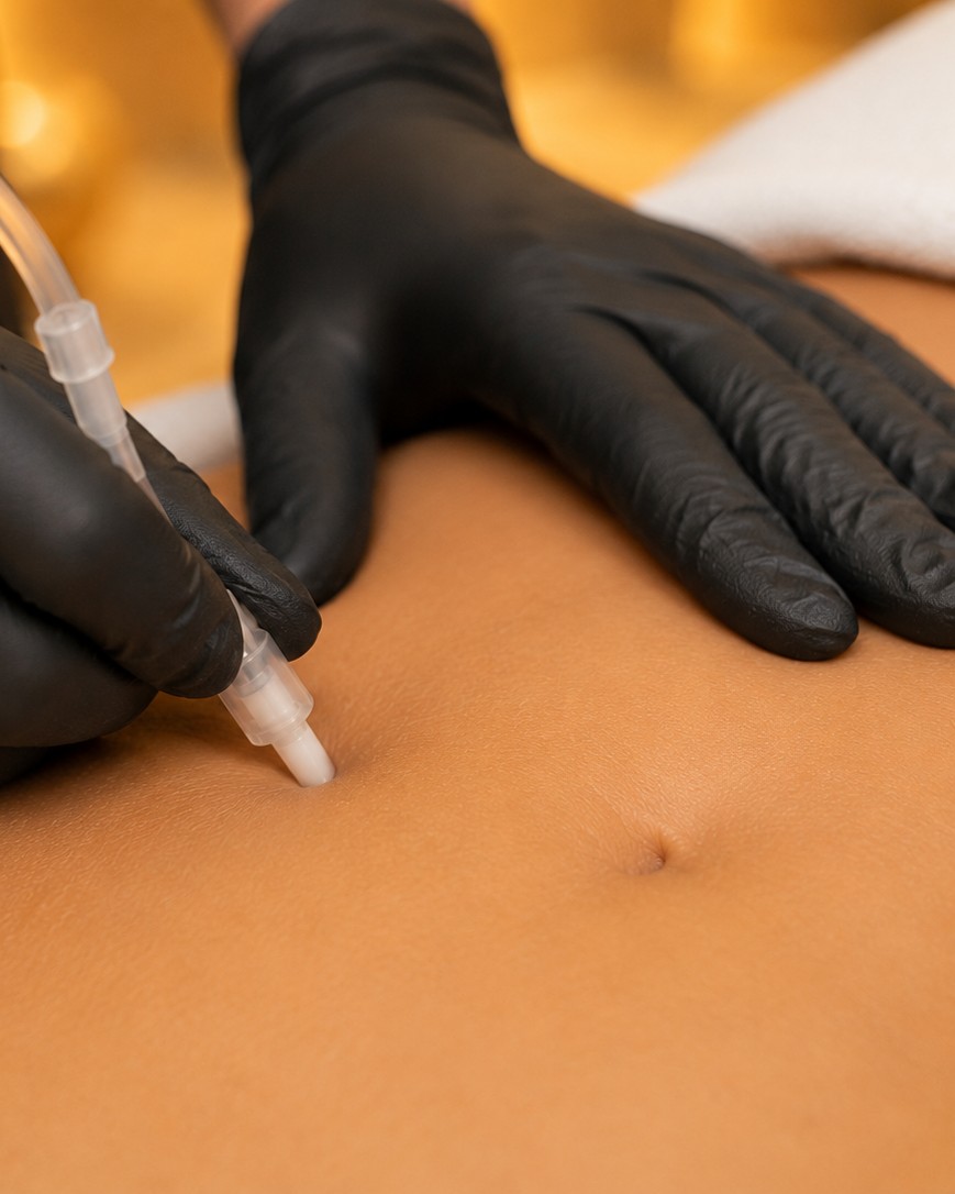 Carboxiterapia