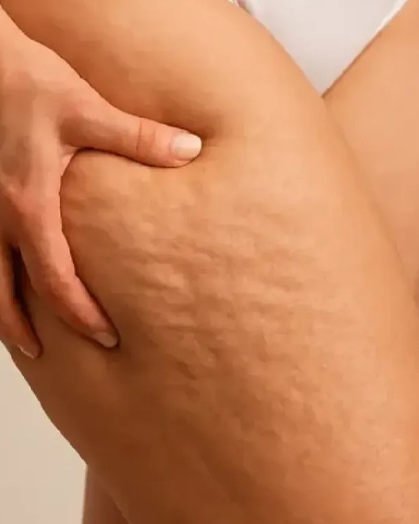 Celulitis